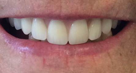 Immediate Initial Placement of Upper Dentures on Day of Extractions
