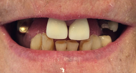 Immediate Initial Placement of Upper Dentures on Day of Extractions