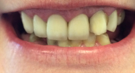 Immediate Maxillary Complete Denture After Extractions