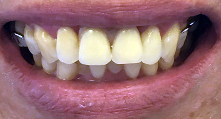 Two Front Teeth Replacement; No Metal Necessary