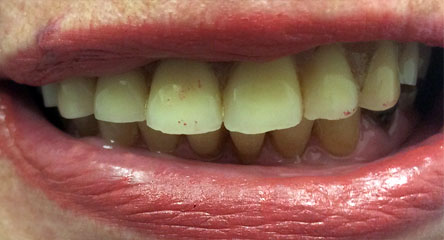 Maxillary Complete Denture Replacement