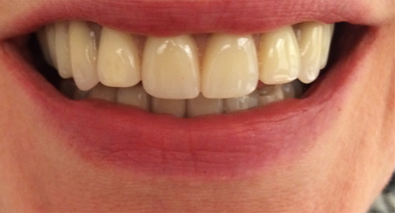 Two Front Teeth Add-On to Existing Upper Denture