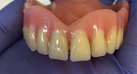 Cleaning An Existing Old Denture