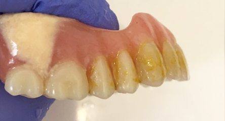 Cleaning Existing Old Denture