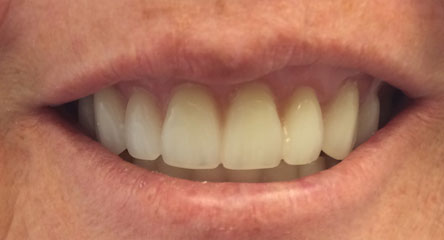 Immediate Upper Denture After Extractions
