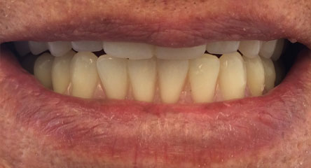 Upper and Lower Replacement Dentures