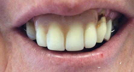 Immediate Upper Denture After Extractions