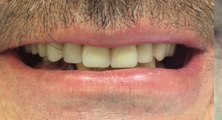 Complete Upper Dentures Immediately After Extractions
