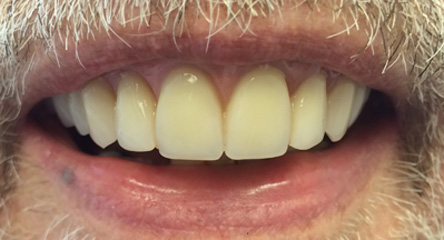 Complete Upper Denture Immediately After Extractions