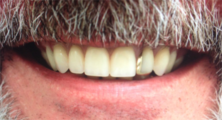 Complete Upper Denture with Gold Onlay Addition
