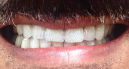 Complete Upper / Lower Denture Replacement