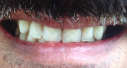 Complete Upper / Lower Denture Replacement