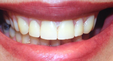 Complete Upper Denture Replacement