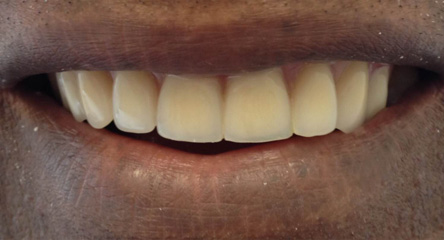 Partial Denture Replacement