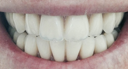 Immediate Initial Placement of Upper / Lower Dentures on Day of Extractions