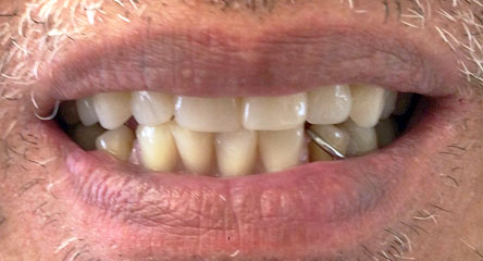 Complete Upper Denture Replacement / Lower Partial Denture Replacement Surrounding Single Tooth Remaining
