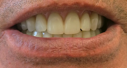 Immediate Initial Placement of Upper / Lower Dentures on Day of Extractions