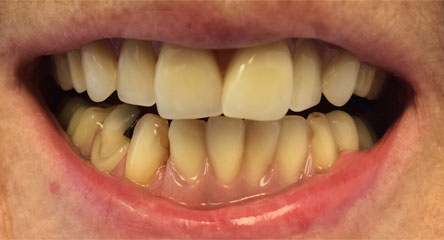 Immediate Initial Placement of Complete Upper Denture / Immediate Initial Lower Placement of Partial Denture