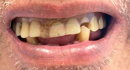 Complete Upper Denture Replacement / Lower Partial Denture Replacement Surrounding Single Tooth Remaining