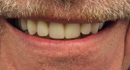 Maxillary Complete Denture Replacement & Mandibular Partial Denture Replacement