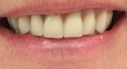 Immediate Maxillary Complete Denture After Extractions