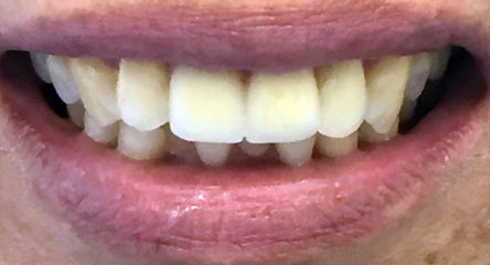 Two Front Teeth Replacement; No Metal Necessary