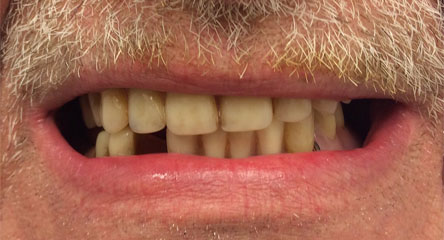 Maxillary Complete Denture Replacement & Mandibular Partial Denture Replacement