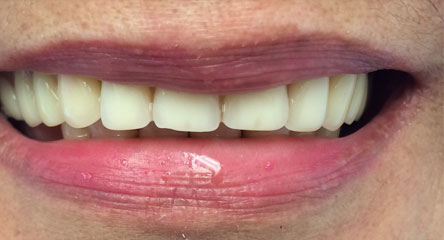 Maxillary Complete Denture Replacement