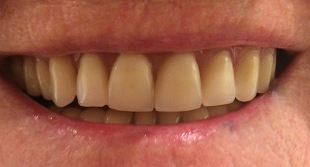 Complete Upper Denture Replacement