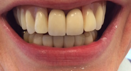 Two Front Teeth Add-On to Existing Upper Denture