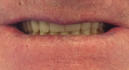 Complete Upper/Lower Denture Replacement