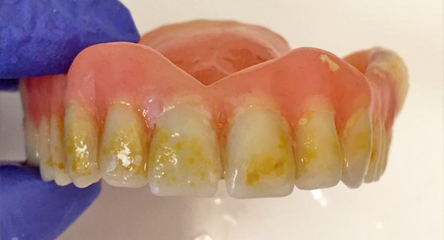 Cleaning An Existing Old Denture