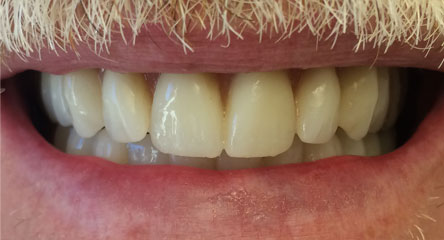 Complete Immediate Upper / Lower Dentures After Extractions