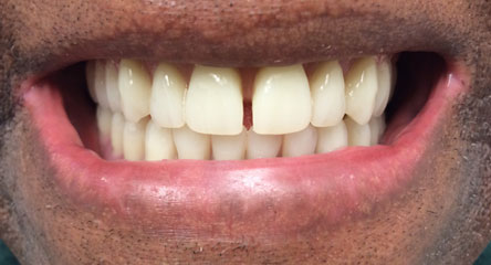 Complete Upper and Lower Replacement Dentures