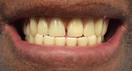 Complete Upper and Lower Replacement Dentures