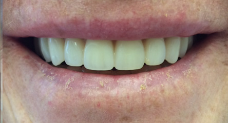 Upper Complete Denture Immediately After Extractions