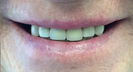 Upper Complete Denture Immediately After Extractions
