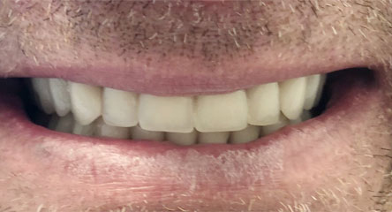 Complete Upper and Lower Arch Dentures