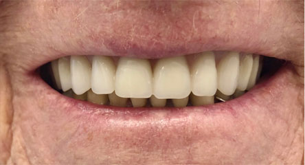 Replacement of Upper Arch Denture
